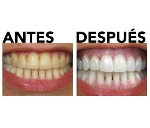 kit de blanqueamiento dental antes y después